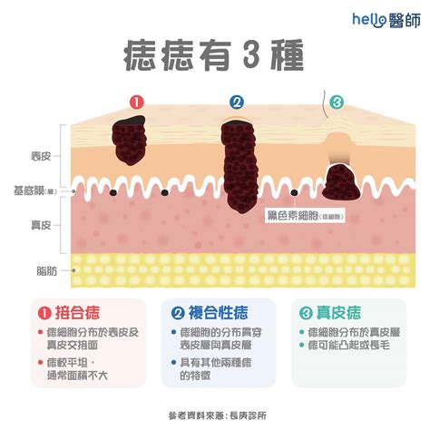 痣生成原因